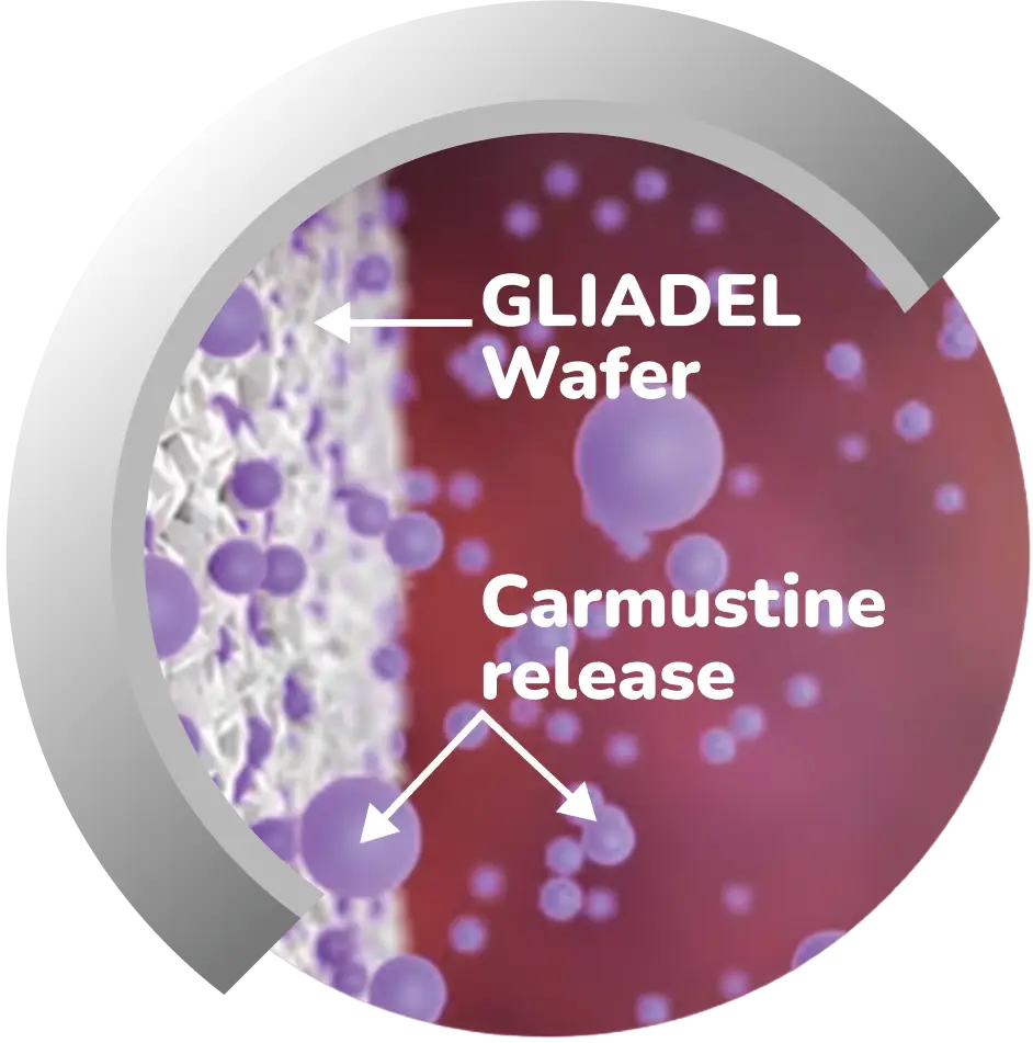 Diagram showing GLIADEL wafer releasing Carmustine in a brain