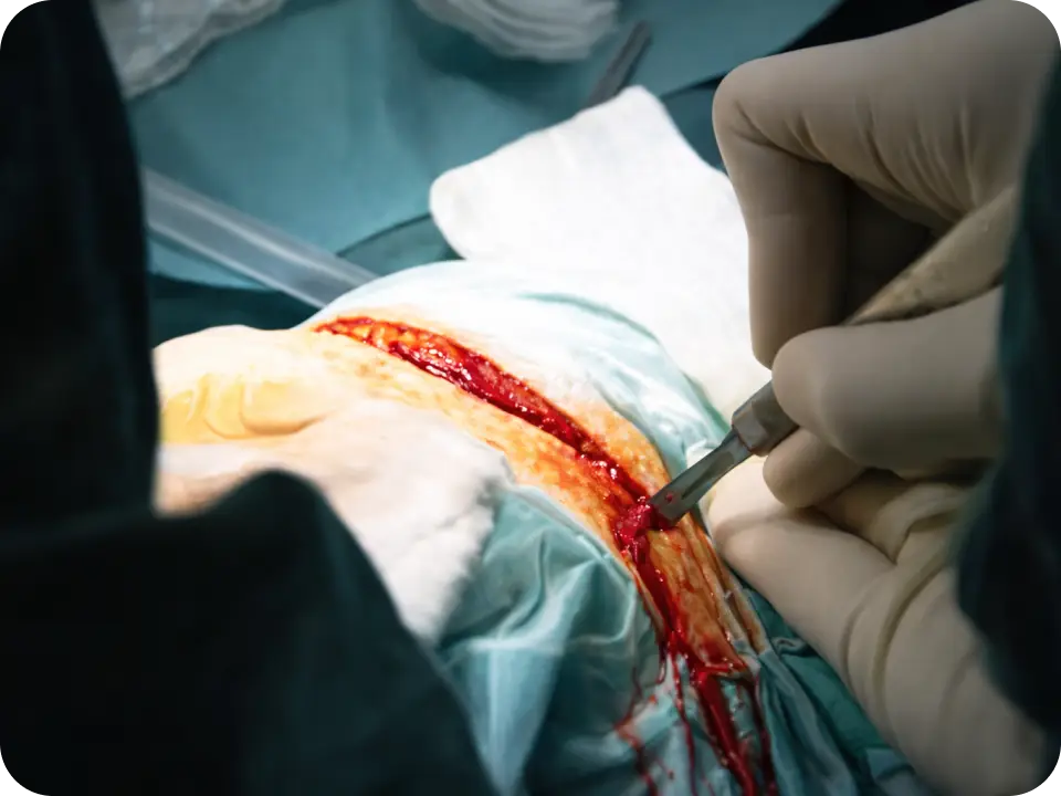 Surgeon making an incision.