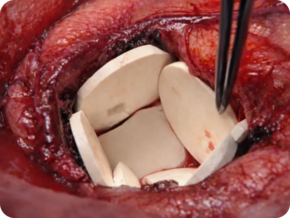 Gliadel Wafer being implanted
