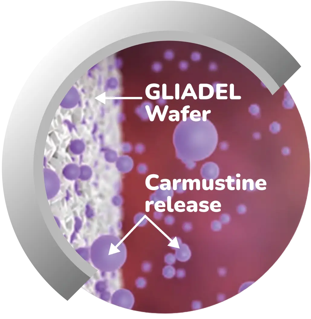Diagram showing GLIADEL wafer releasing Carmustine in a brain