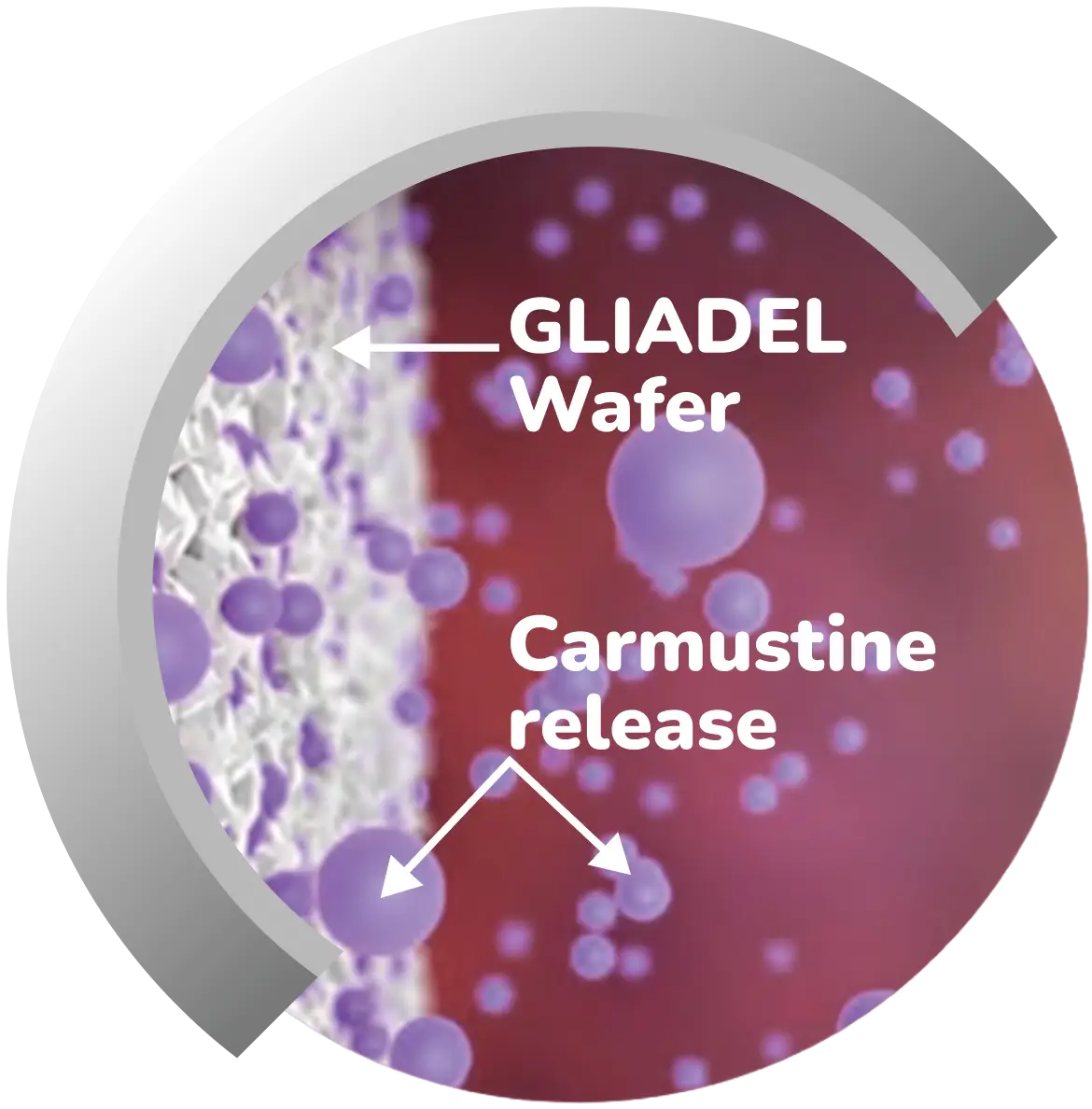 Diagram showing GLIADEL wafer releasing Carmustine in a brain
