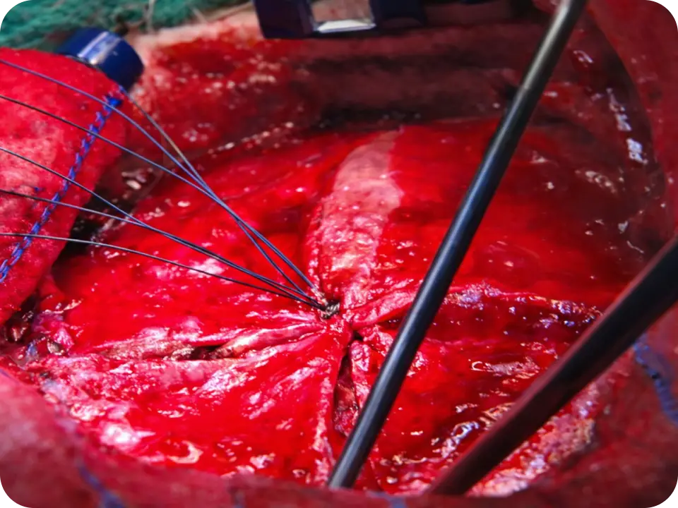 Surgical site being stitched close.
