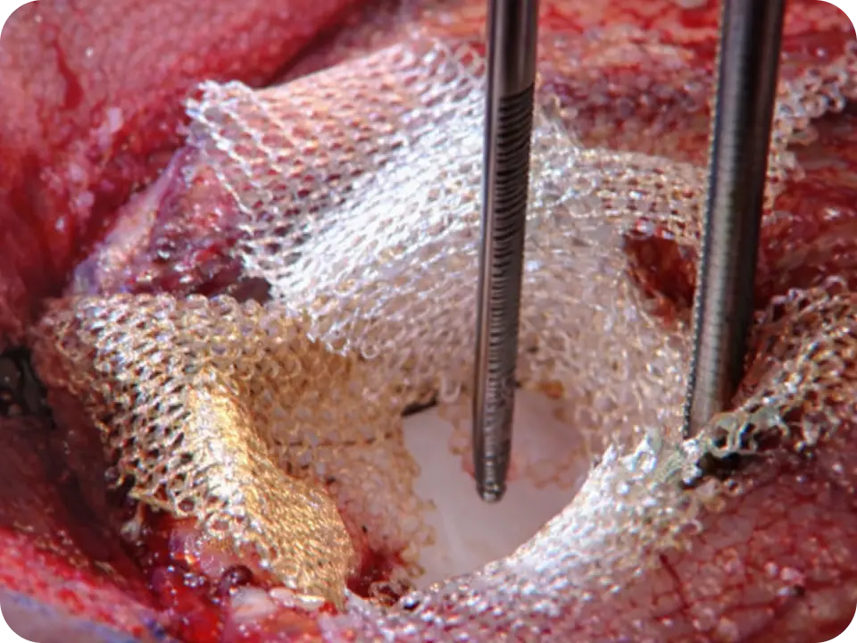 Gauze being placed in the surgical site.